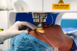 Laser vision operation